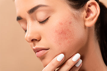 Troubled with Acne and Oily Skin? Say No More.