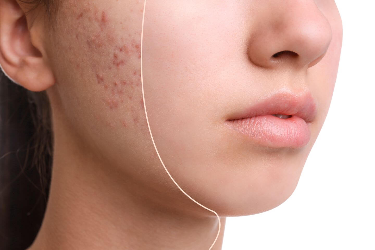 Top 5 Accutane Alternatives for Effective Acne Treatment