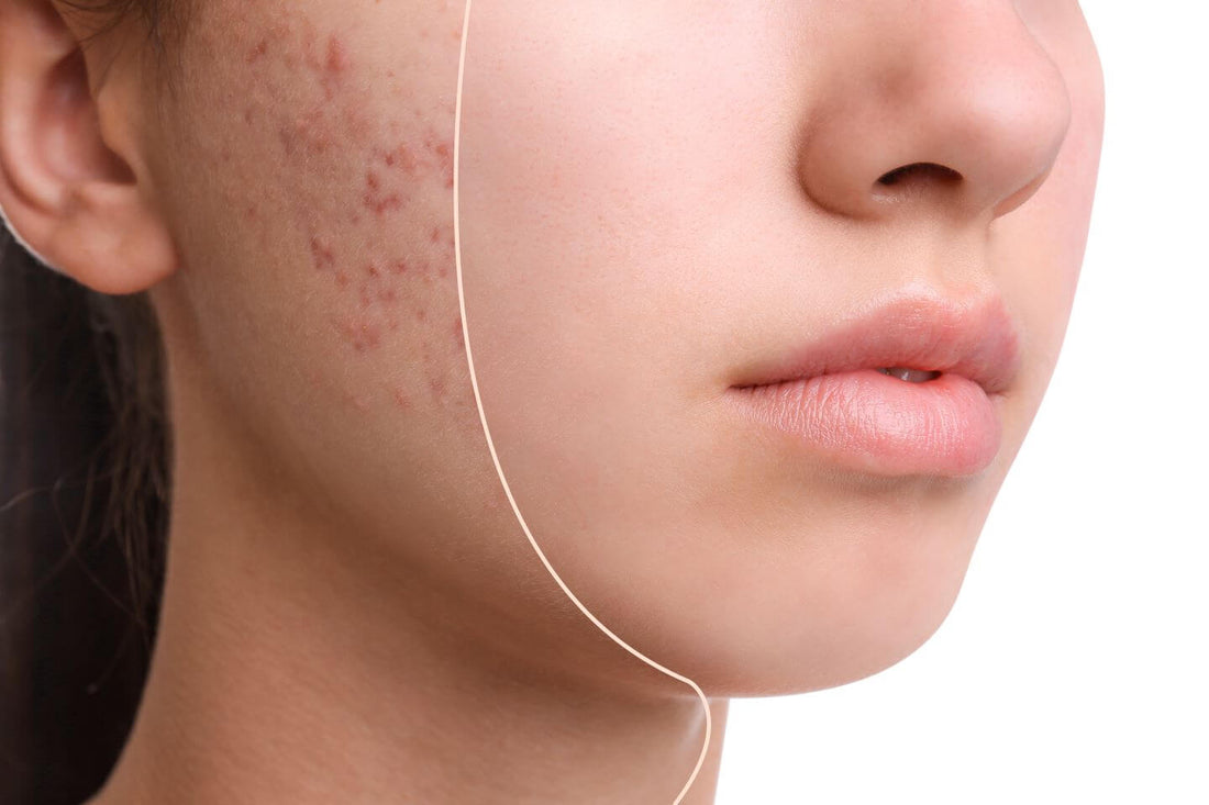 Top 5 Accutane Alternatives for Effective Acne Treatment