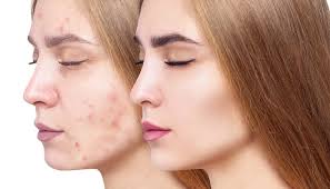 Understanding Global Demand for Anti-Acne Solutions: Trends and Opportunities