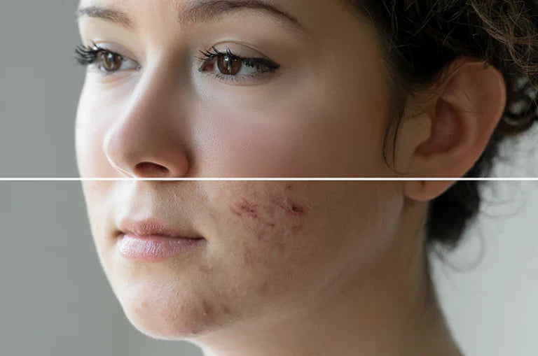 Accutane: What You Need to Know About This Acne Treatment