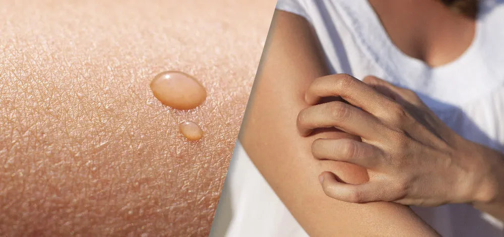 What is Ichthyosis? Types, Symptoms, & Treatment